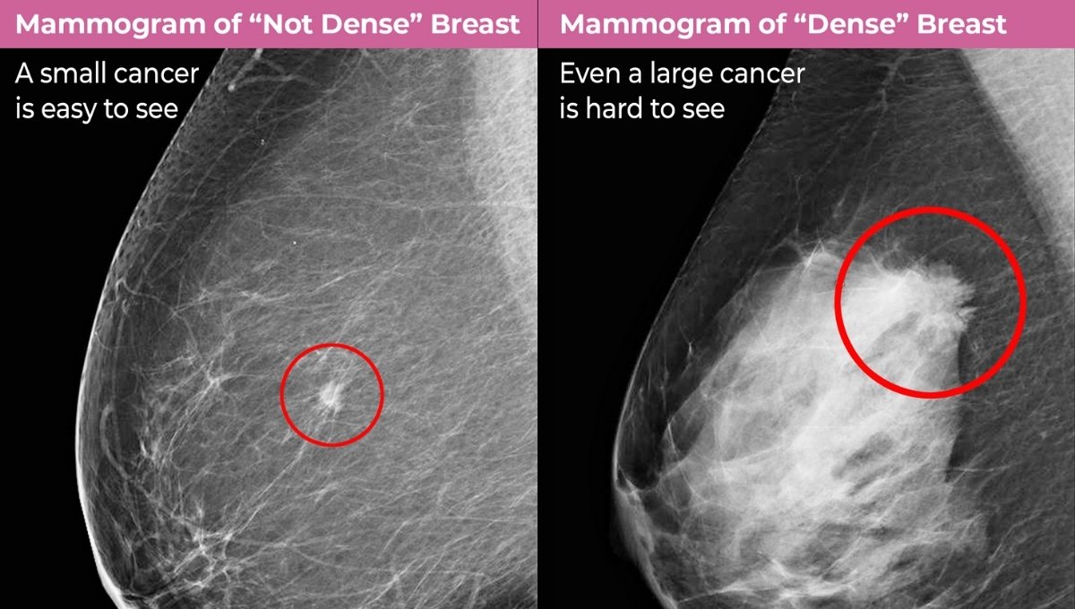 Dense Breast Risk